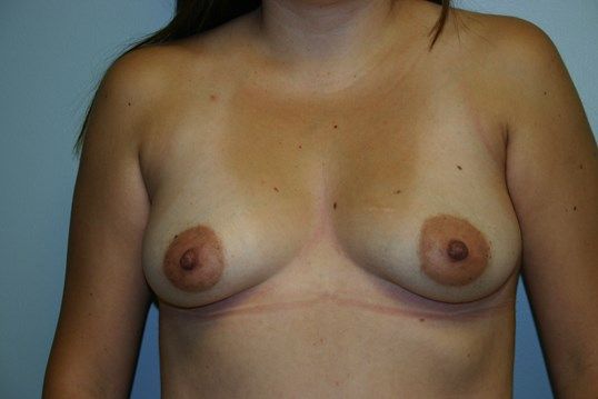 Breast Augmentation Before & After