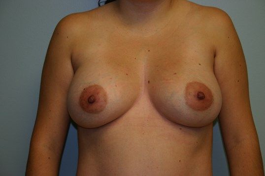 Breast Augmentation Before & After