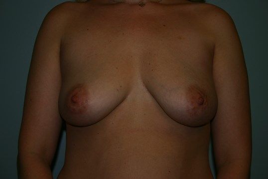 Breast Augmentation Before & After