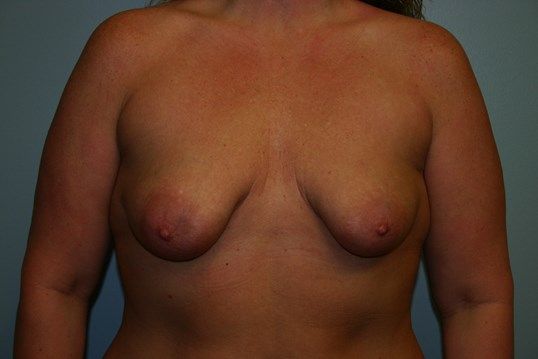 Breast Augmentation Before & After