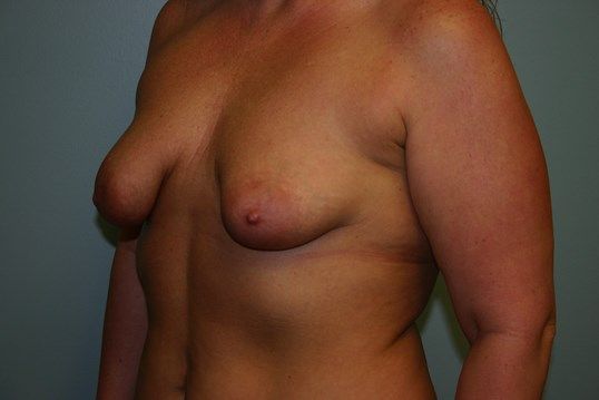 Breast Augmentation Before & After