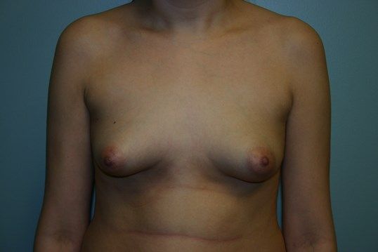 Breast Augmentation Before & After