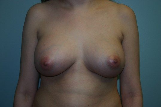 Breast Augmentation Before & After