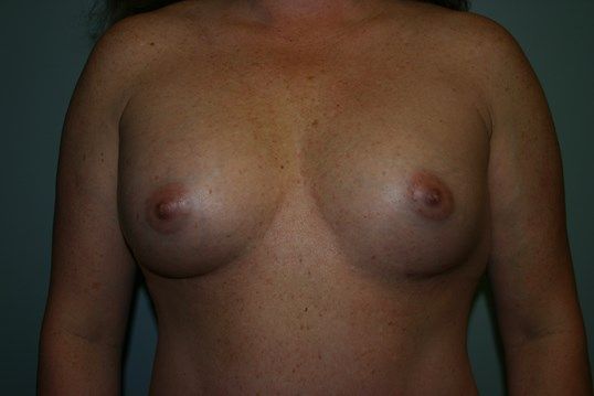 Breast Augmentation Before & After