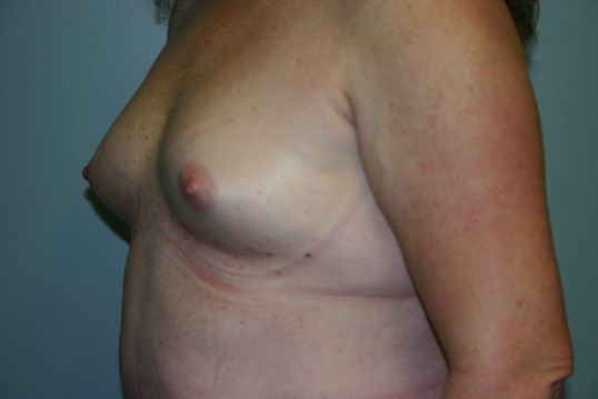 Breast Augmentation Before & After