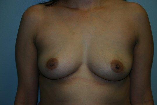 Breast Augmentation Before & After