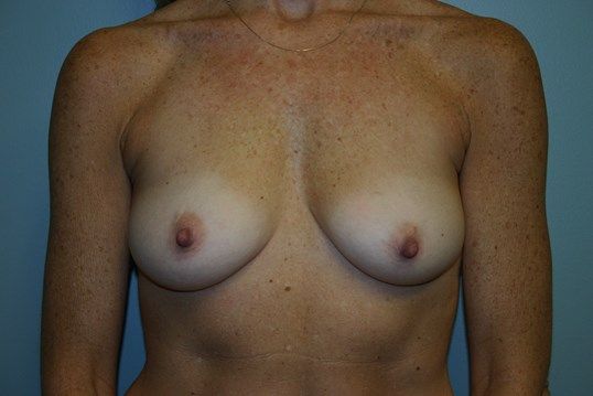 Breast Augmentation Before & After