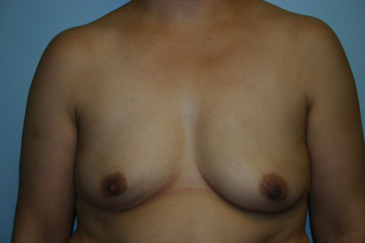 Breast Augmentation Before & After