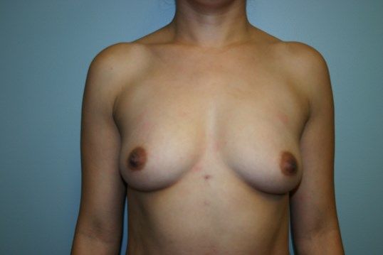 Breast Augmentation Before & After