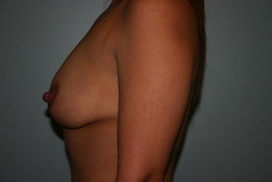 Breast Augmentation Before & After