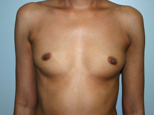 Breast Augmentation Before & After