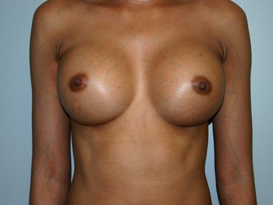Breast Augmentation Before & After