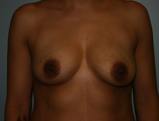 Breast Augmentation Before & After