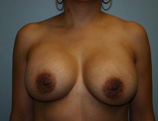 Breast Augmentation Before & After