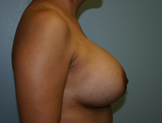 Breast Augmentation Before & After