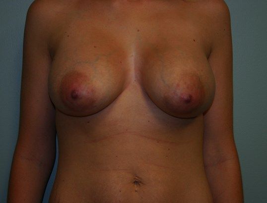 Breast Augmentation Before & After