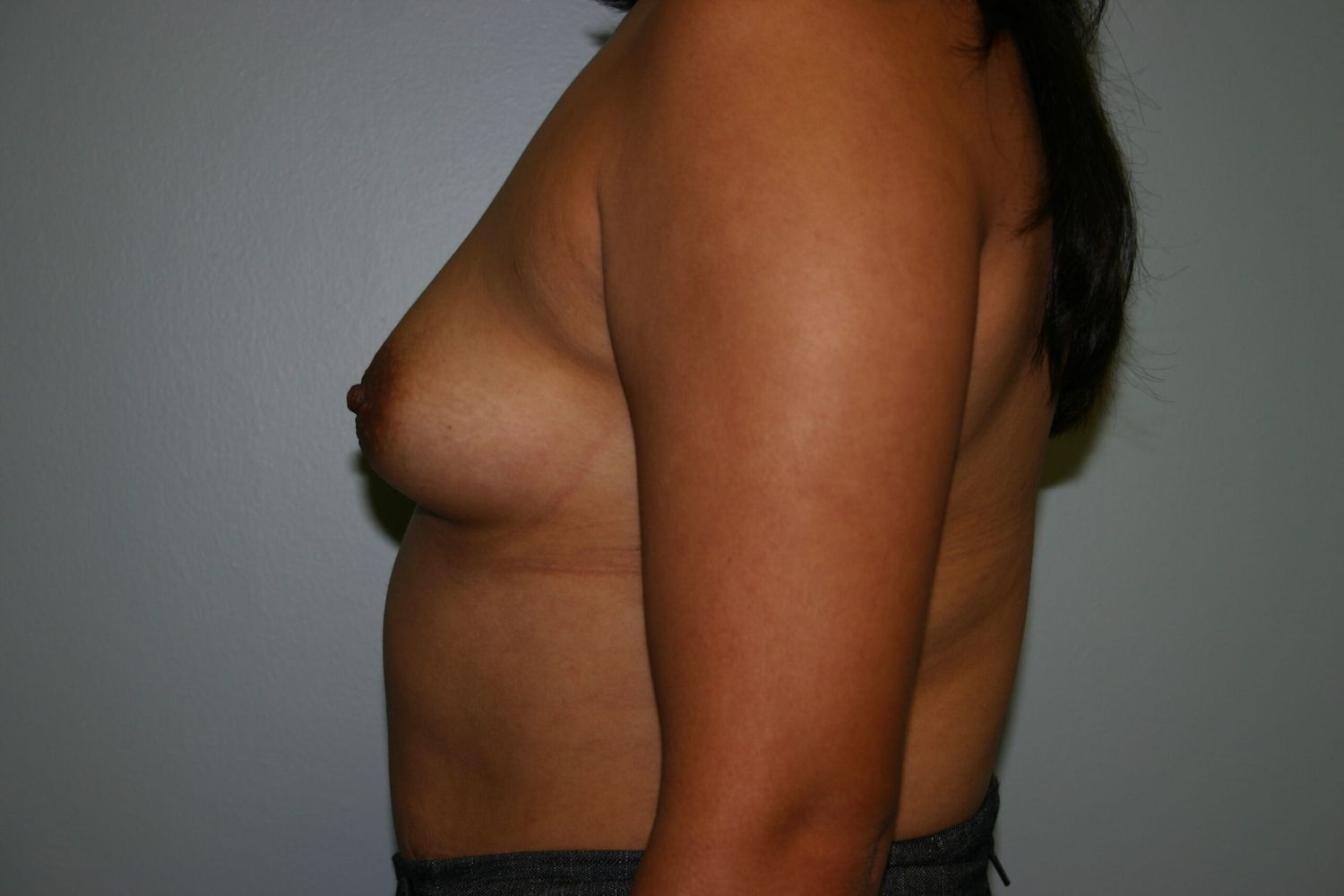 Breast Augmentation Before & After