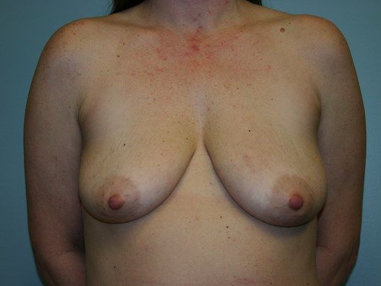 Breast Augmentation Before & After