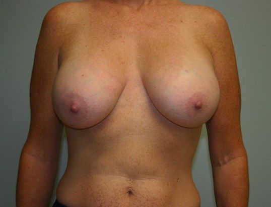 Breast Augmentation Before & After