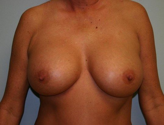 Breast Augmentation Before & After