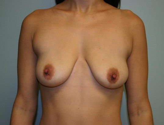 Breast Augmentation Before & After
