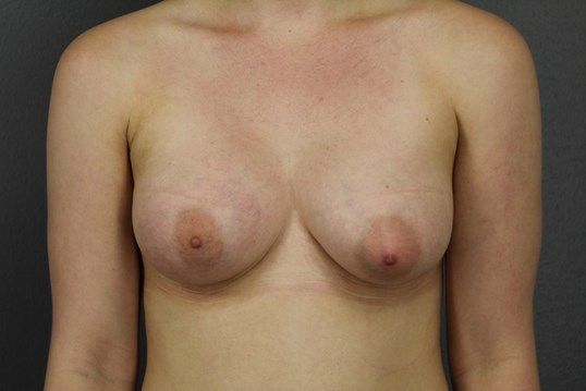 Breast Augmentation Before & After