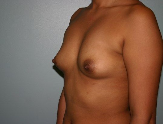 Breast Augmentation Before & After