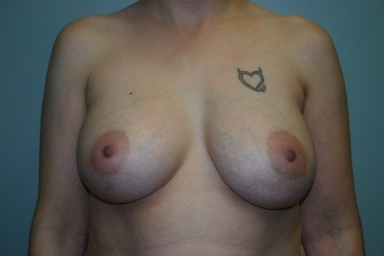 Breast Augmentation Before & After