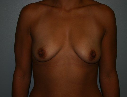 Breast Augmentation Before & After