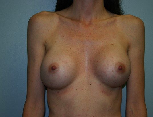 Breast Augmentation Before & After