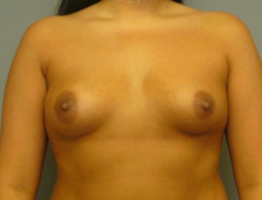 Breast Augmentation Before & After