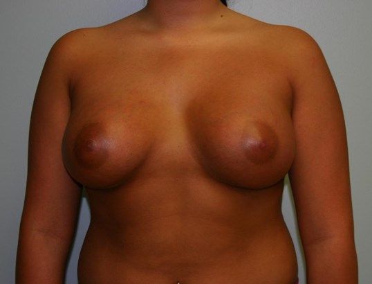 Breast Augmentation Before & After