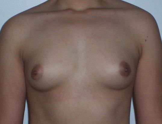Breast Augmentation Before & After