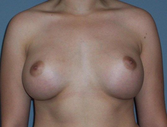 Breast Augmentation Before & After