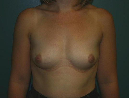 Breast Augmentation Before & After