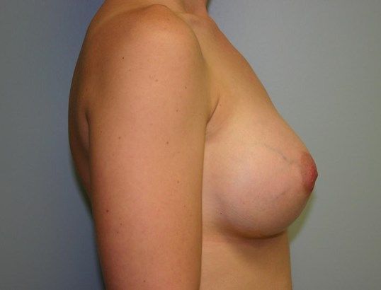 Breast Augmentation Before & After