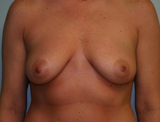 Breast Augmentation Before & After