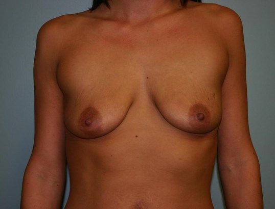 Breast Augmentation Before & After