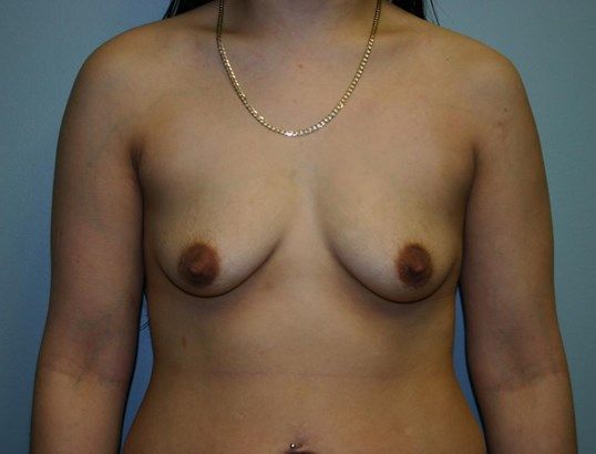 Breast Augmentation Before & After