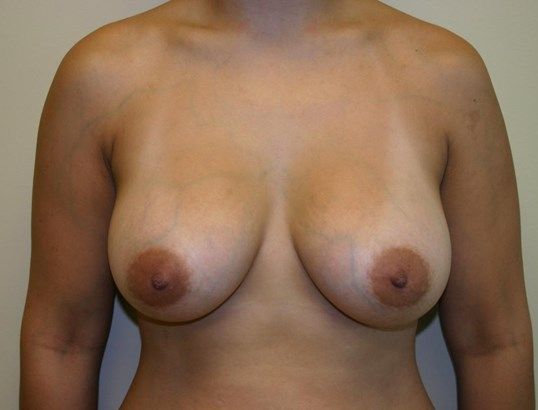 Breast Augmentation Before & After