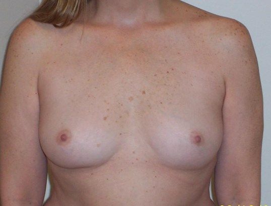 Breast Augmentation Before & After
