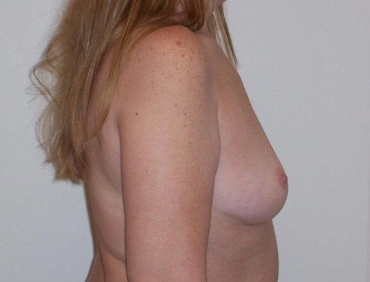 Breast Augmentation Before & After