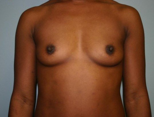 Breast Augmentation Before & After