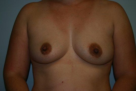 Breast Augmentation Before & After