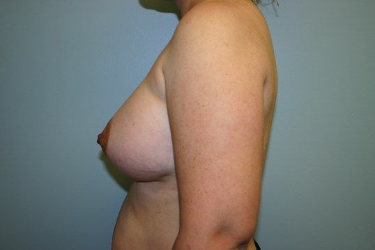 Breast Augmentation Before & After