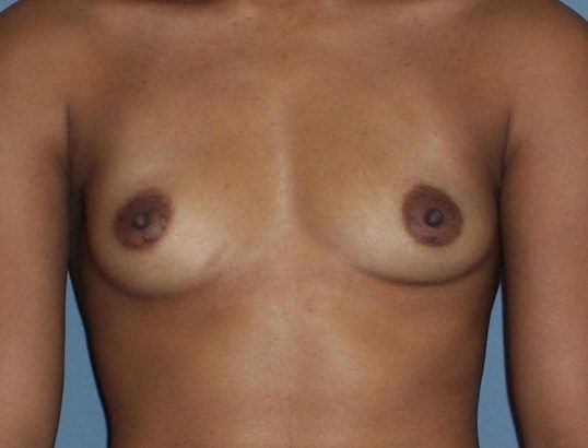 Breast Augmentation Before & After