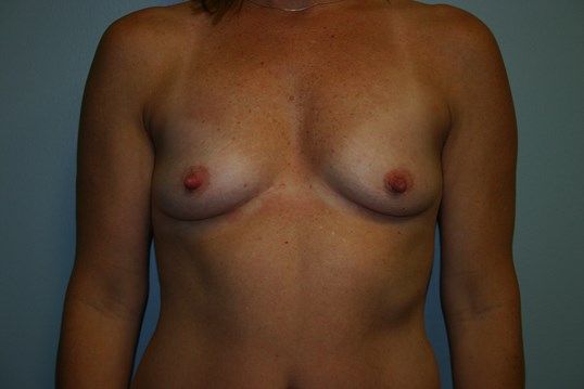 Breast Augmentation Before & After