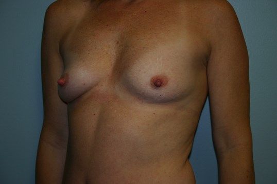 Breast Augmentation Before & After