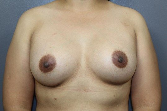 Breast Augmentation Before & After