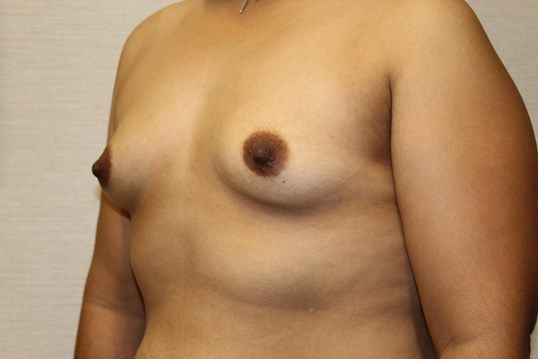 Breast Augmentation Before & After